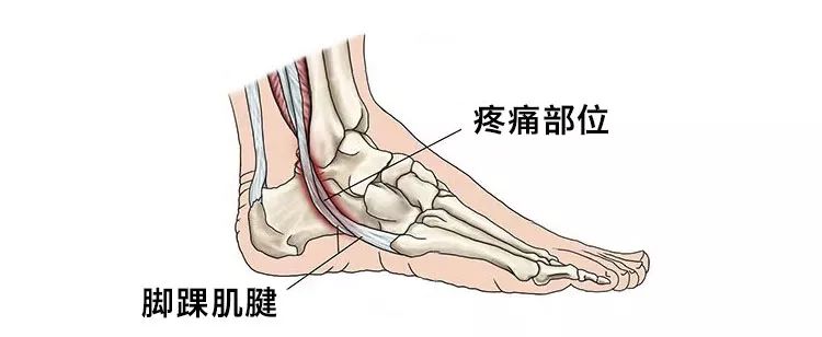 跟腱炎疼痛部位示意图